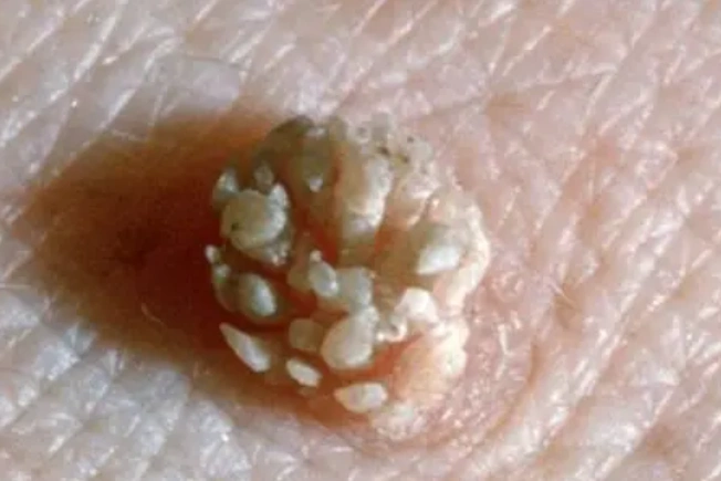 "手艺"男孩一月60次,感染hpv私处长满"菜花",医生看了摇头