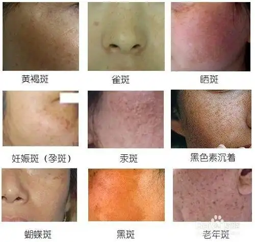 岳阳亲草,让你的容貌重回18岁!_色斑