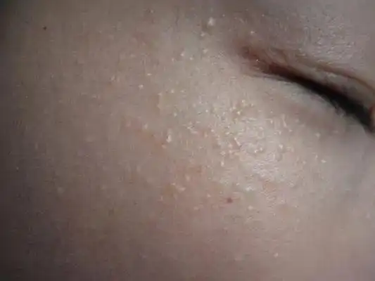 其实脸上的疹子不一是脂肪粒,有可能是粟丘疹.