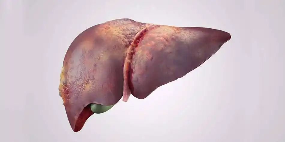 酒精肝该如何诊断?又该如何预防?看完就明白了