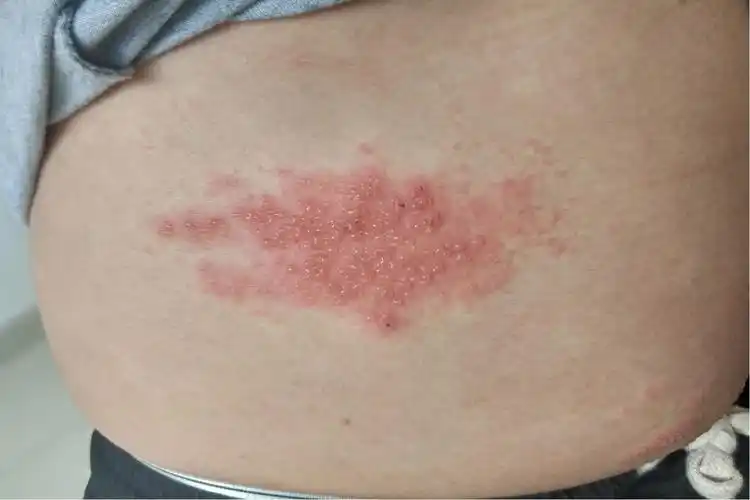 疱疹图片和症状图片 男性腰部