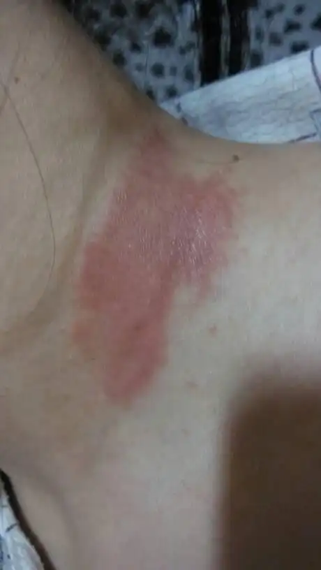 我脖子上这个刚开始是一粒豆 很痒 抓着抓着一个月变成了一片红红的