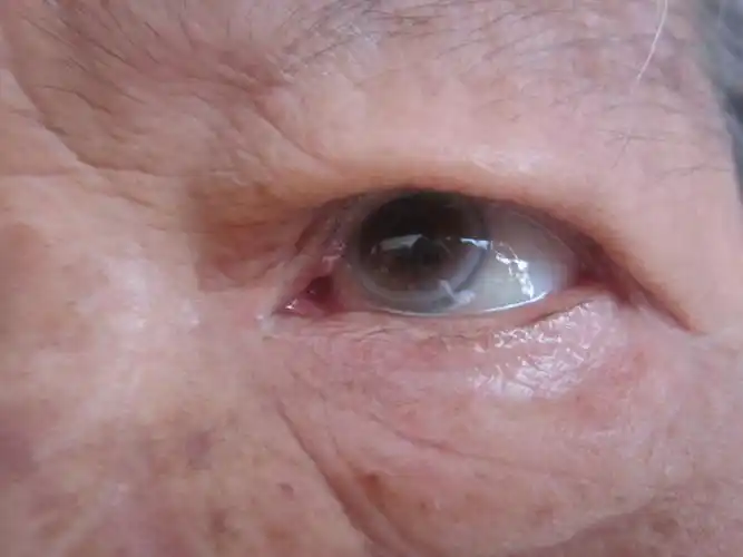 80岁聋哑老太眼病