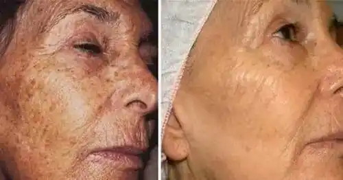 老年斑是怎么形成的这样去掉老年斑更显年轻