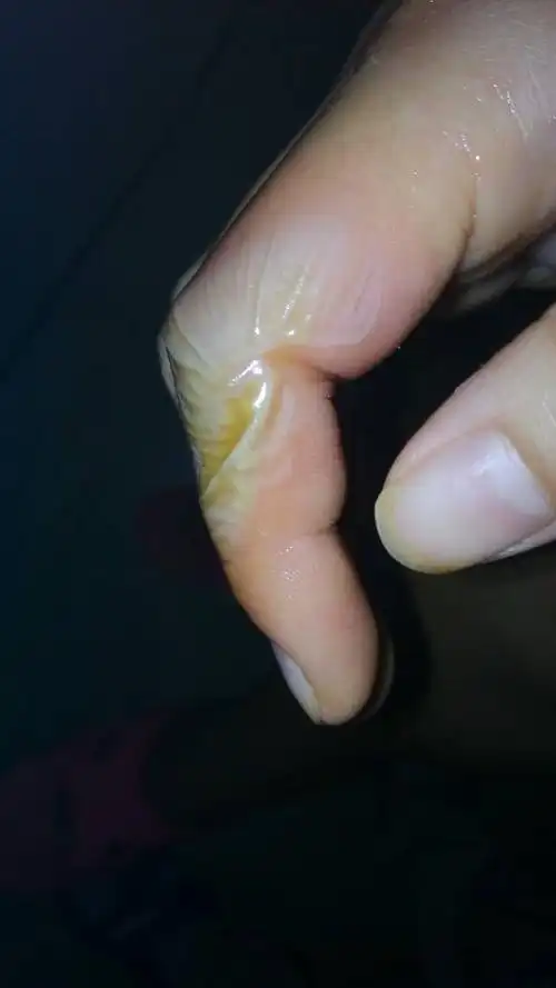 手放烟花时烫伤伤口怎么处理?着急!谢谢!