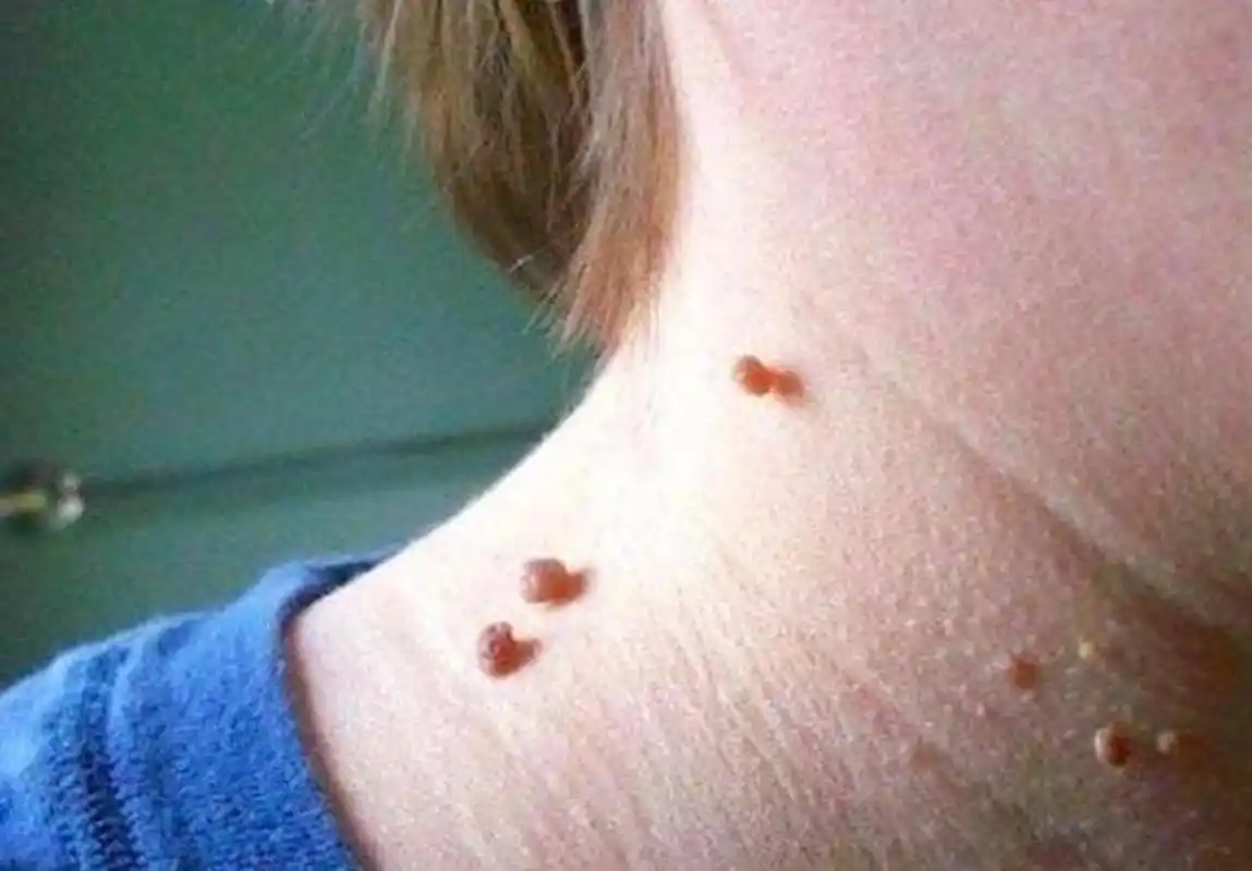 见图,这种疣叫丝状疣,是感染低危型hpv引起的,生活中有很多人用寿抠