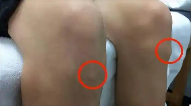 根据疼痛的部位和症状,分别有以下几种:胫骨结节骨骺炎,髌骨半脱位