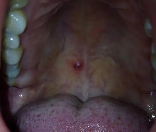 最近发现口腔上颚长了个米粒大小的疙瘩,开