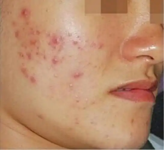 婴儿痤疮图片_有来医生