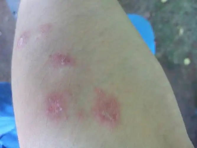 我这个是梅毒吗?我这个痒死.求答案.