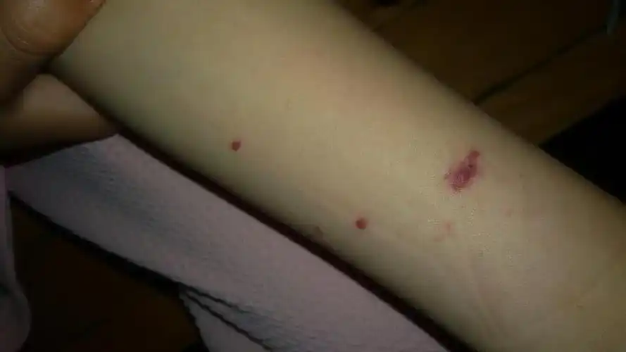 被蚊子咬了变成紫色怎么回事?