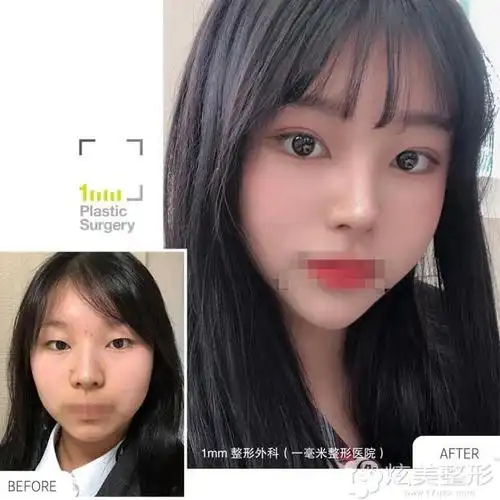 双眼皮 硅胶隆鼻前后对比案例