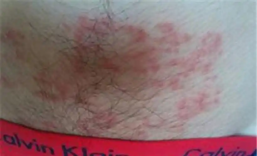 非淋病的晚期症状图片_有来医生