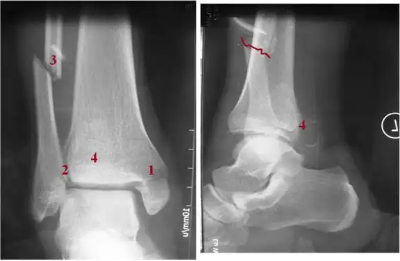 三踝骨折的损伤机制及特殊性分析-骨医小灶第二十四期(上)