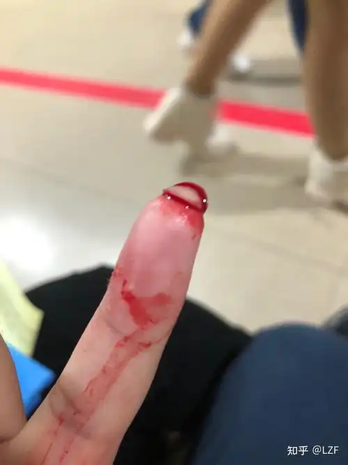 记录左手小手指受伤