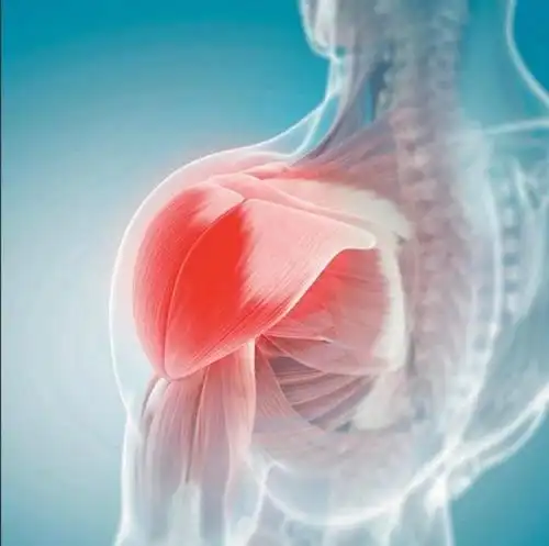 肩周炎早期有几个特点,疼痛是一把抓,最疼的点叫三角肌,三角肌指点