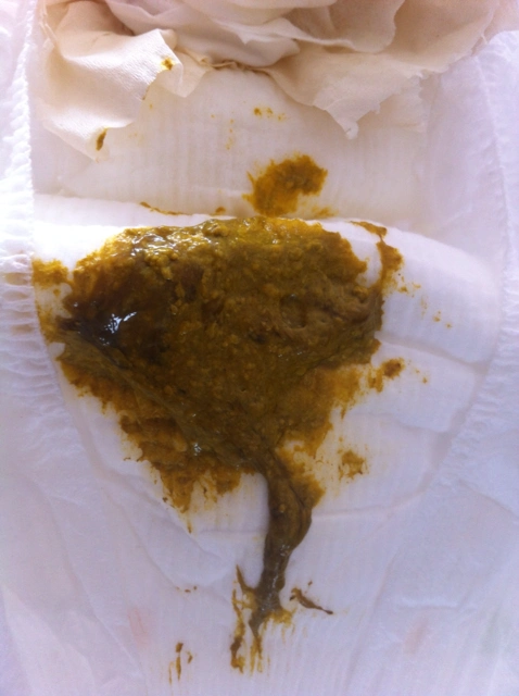 宝宝这两天拉大便像痰一样