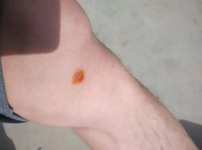 皮肤一夜长一块橘皮