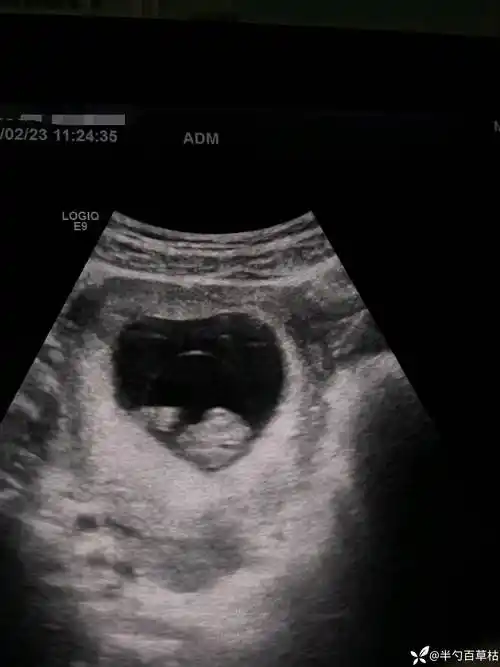 丁香园论坛>超声医学>帖子详情>羊膜囊起初只是覆盖胚胎背侧的一个小