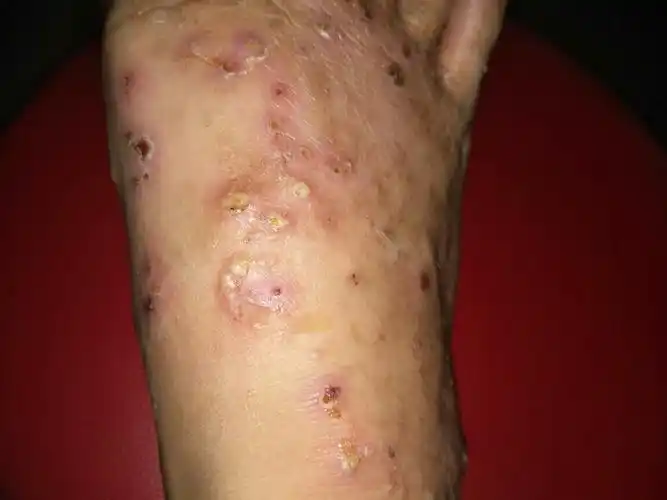 脚上长了很多东西,还有浓泡,非常的疼,有没有在线的医生或者是知道的