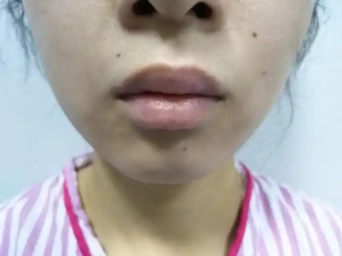 我认为自己唇形难看,医生看过之后说是上唇过厚外翻,_圈子-新氧美容