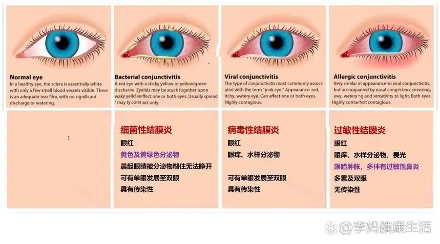 简单的结膜炎鉴别技巧