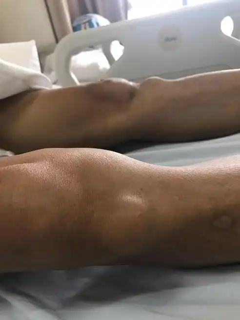 患上怪病智力退化,30多年找不出病因,医生从这个细节发现端倪