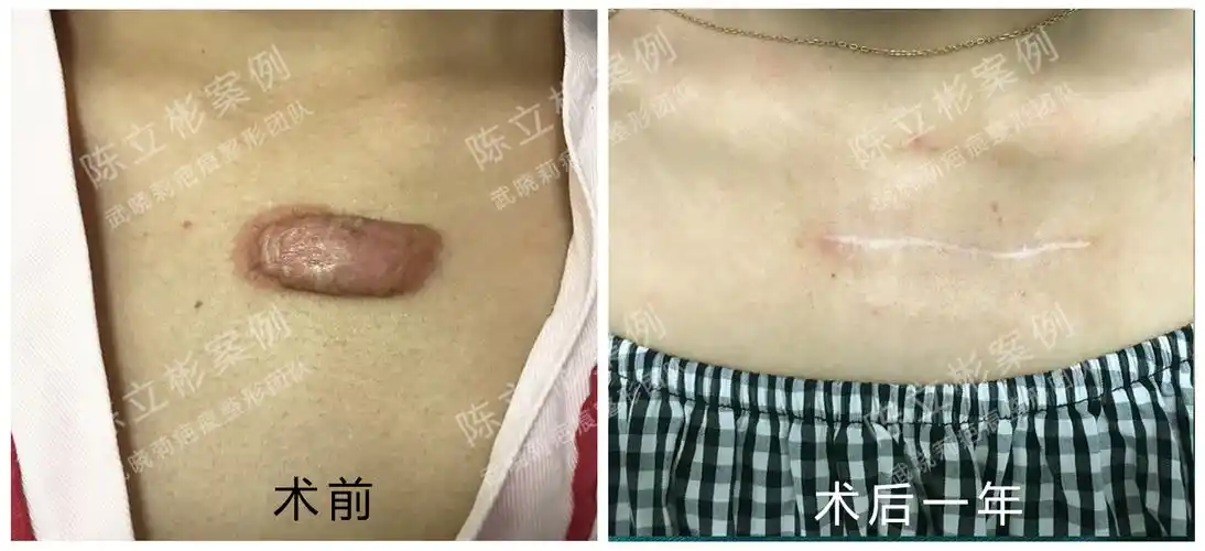 手术案例│胸部疤痕疙瘩 - 好大夫在线