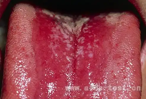 艾滋病初期症状之白色念珠菌感染图片