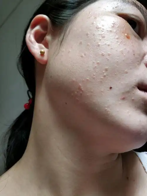 脸上长小疙瘩除了可能是汗管瘤还可能是这些疾病