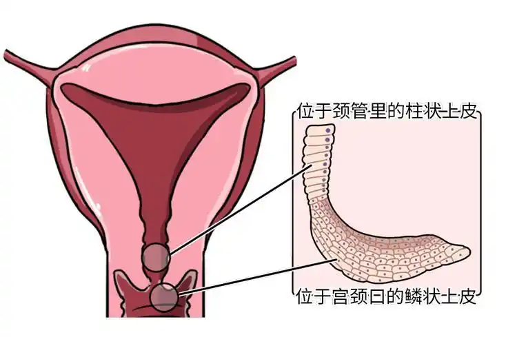 宫颈有两种"皮肤"何况这糜烂还发生在宫颈上就自带吓人属性光糜烂两个