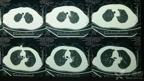 请问这个69岁女性ct扫描结果肺癌风险多大?