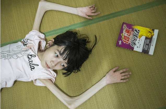 成绩优异的女孩身患肌肉萎缩症,但是她依然乐观面对生活,坚持在