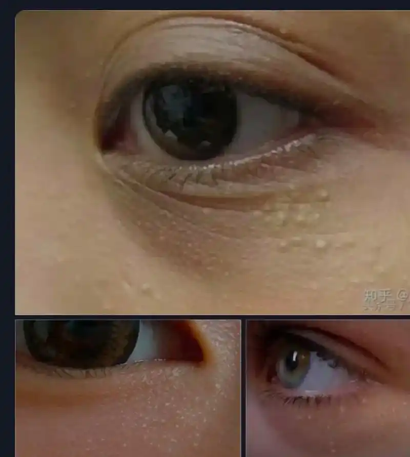 油脂粒的形成:由于皮肤新陈代谢缓慢,擦得护肤品吸收不了,从而 - 抖音