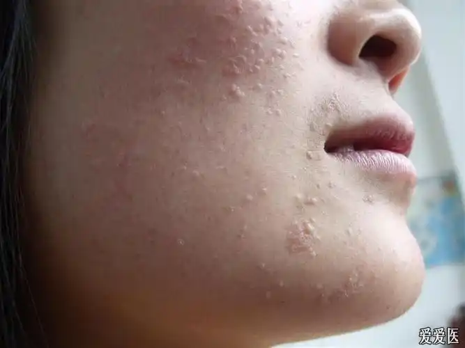 扁平疣治疗经过