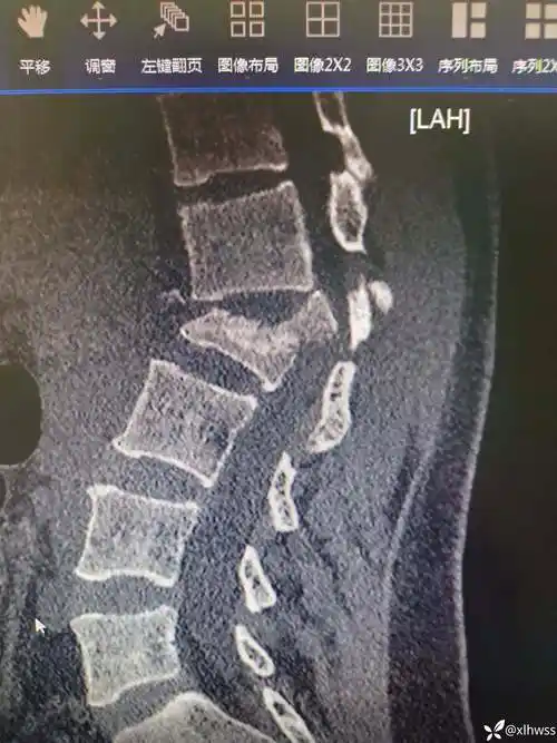 高处跌落腰椎爆裂骨折