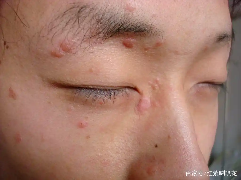 外卖小哥脸上长满疙瘩,遭客户投诉,医生:快去查hpv,八成是疣