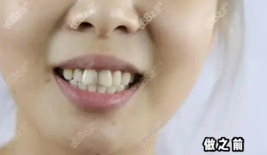 门牙往外突出的最快矫正方法竟是这个!亲测好用且费用不贵