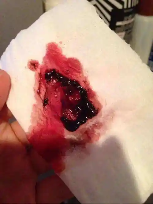 月经血块多是怎么回事人流后月经血块多是怎么回事