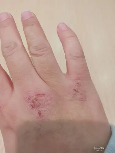 湿疹性皲裂擦什么药膏?