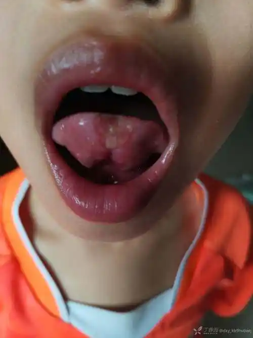 舌尖反复溃疡灶三年