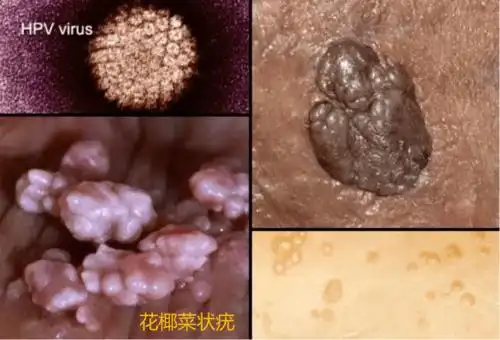 低危型黏膜hpv很少致癌,多是在男性和女性的生殖器,肛门周围长出