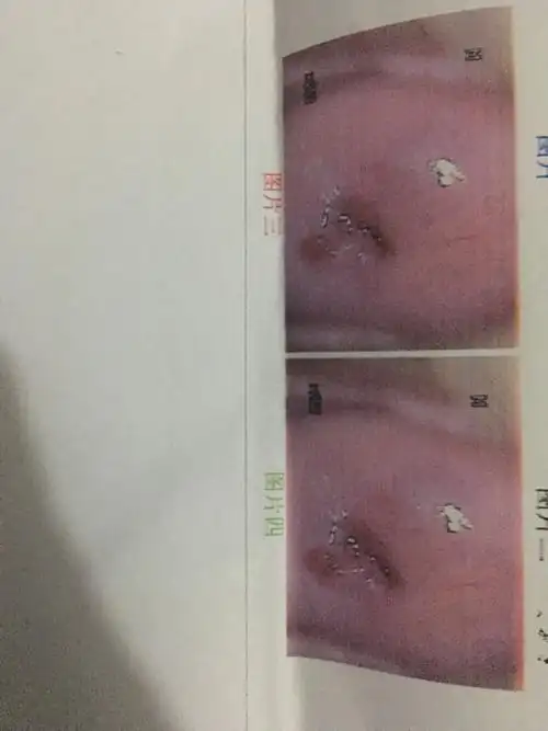 昨天去做了检查说怀孕有八周了,子宫有些炎症现在怎么办