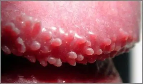 珍珠状阴茎丘疹的介绍