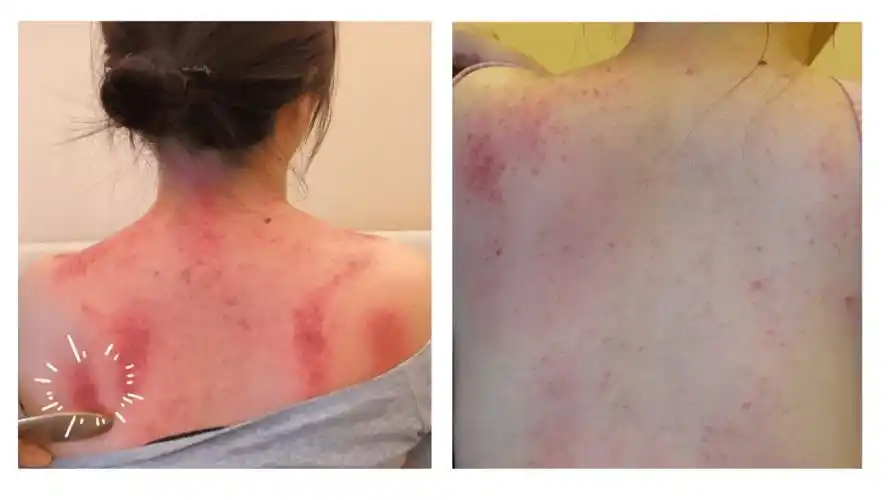 背部刮痧(刮痧背部图片)