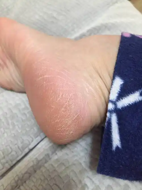 女人脚后跟干裂,怎么办?_问题_都会_皮肤