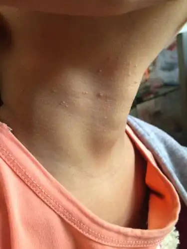 请问一下这是扁平疣吗?宝宝说不痒也不痛,不过摸起来感觉有点粗糙!