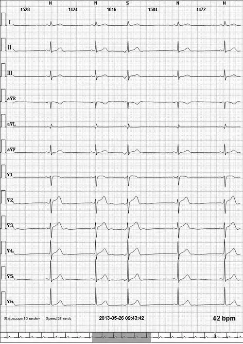请版主老师看看这份心电图如何诊断 - 心电图脑电图专业讨论版 - 爱爱