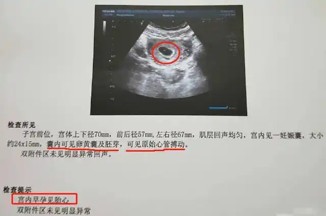 六周的孕囊能看出怀几个孩子吗孕早期通过孕囊形状看男女不靠谱