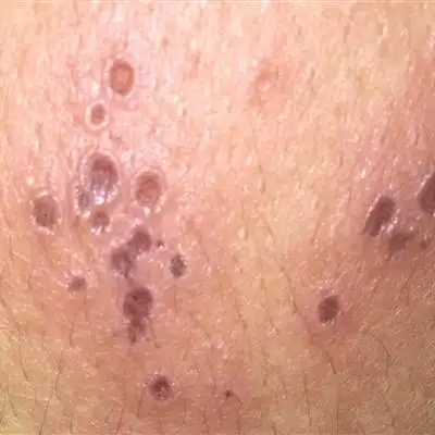 龟头珍珠疹有多少人有?